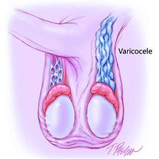 varicocèle testiculaire et infertilité masculine