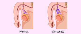 varicocèle varice testicule cause symptômes remèdes